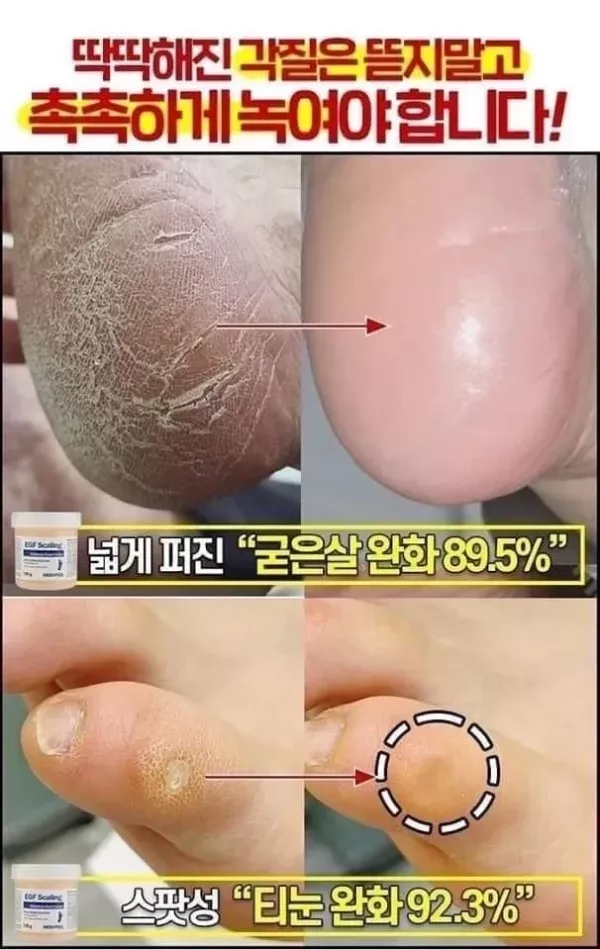 Medi - Peel Egf 修復護足霜 