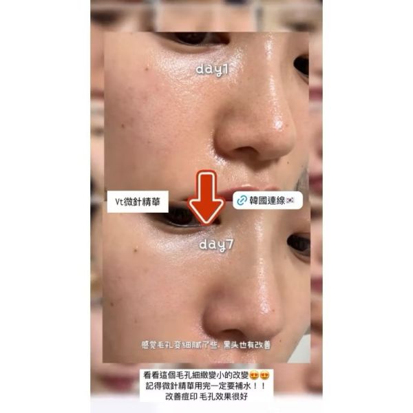 VT微針精華 