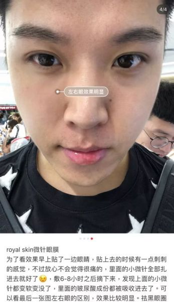 ROYAL SKIN 玻尿酸微針眼膜 