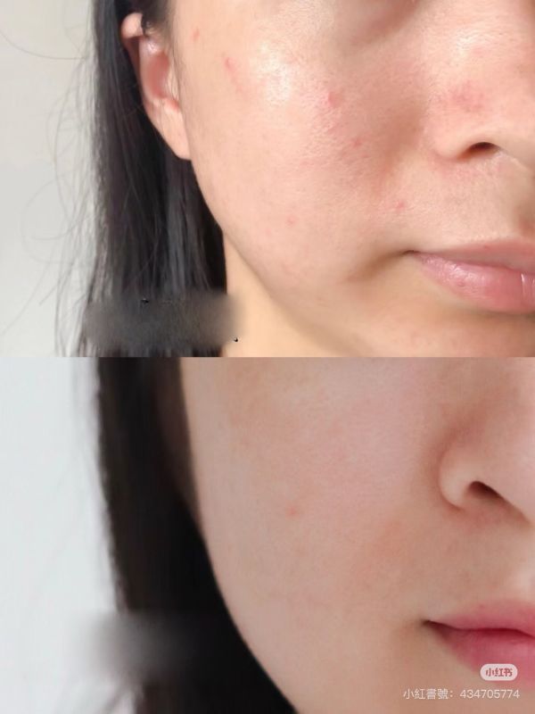 施顏適水楊酸棉片（兩款） 