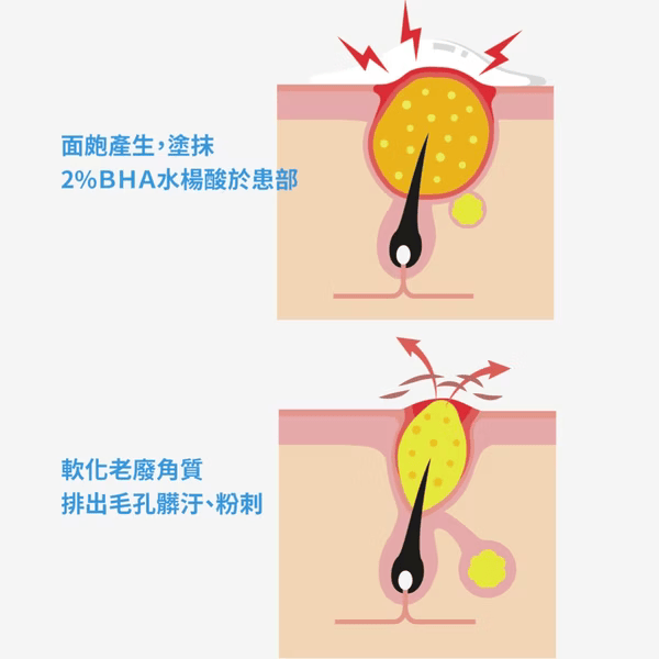 ▍限時團購 ▍2%水楊酸面皰調理凝露 30ml｜BRIDGE 24/7 