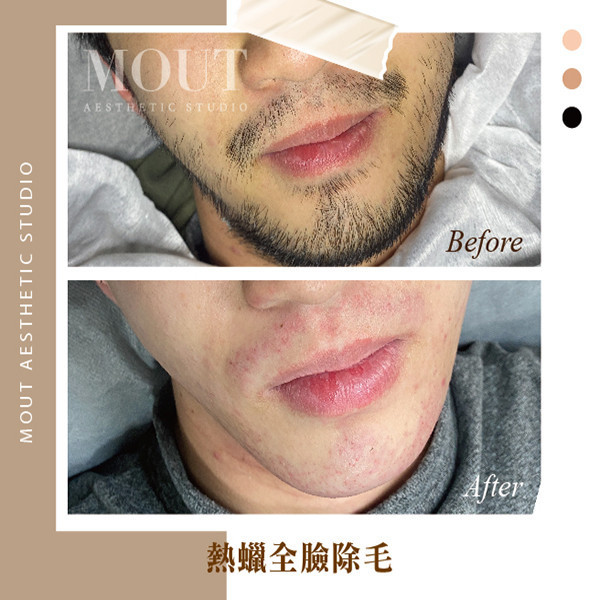 男士熱蠟美肌除毛 