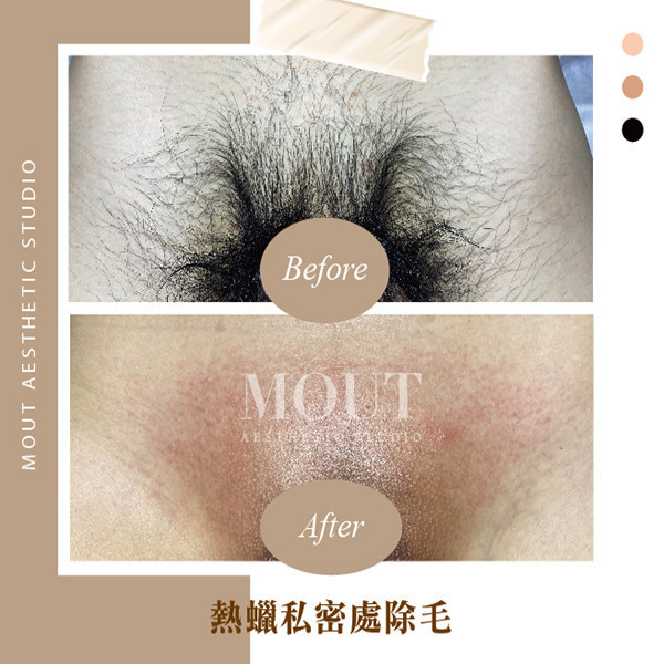 男士熱蠟美肌除毛 